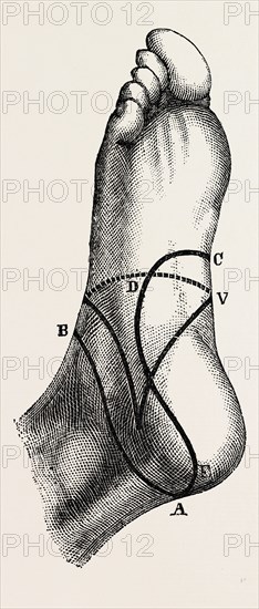 inner and outer sides of the right foot, to show the incisions, medical equipment, surgical instrument, history of medicine