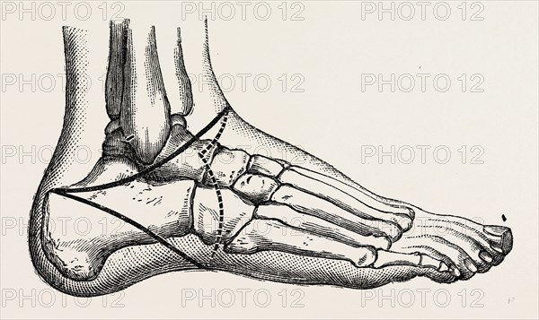 roux's amputation, medical equipment, surgical instrument, history of medicine