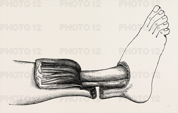 teale's amputation of the leo, medical equipment, surgical instrument, history of medicine