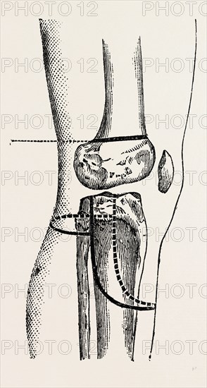 farabeuf's amputation, medical equipment, surgical instrument, history of medicine