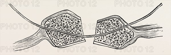 the fragments cut square and the wire in position, medical equipment, surgical instrument, history of medicine