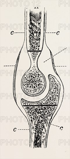 diagrams to illustrate the sub-periosteal method of resection, medical equipment, surgical instrument, history of medicine