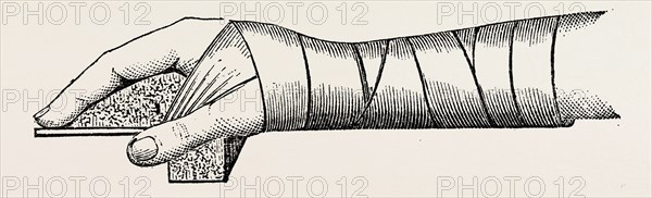 lister' s splint for excision, medical equipment, surgical instrument, history of medicine