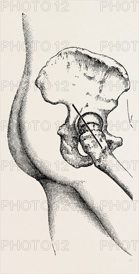 excision of the hip, medical equipment, surgical instrument, history of medicine