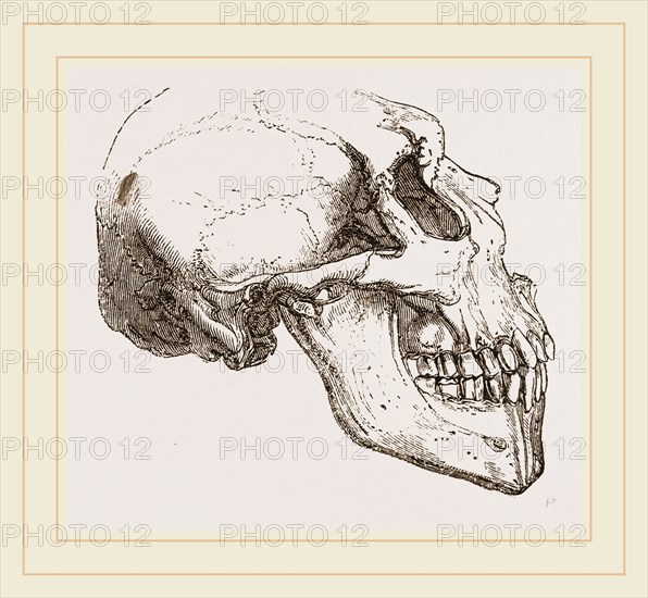 Skull of Human Idiot