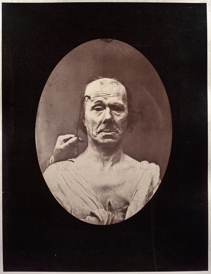 Mécanisme de la physionomie humaine: Figure 7: Étude du méchanisme et de l'expression du muscle frontal chez un vieillard: à droit, attention; à gauche, repos, c. 1856. Guillaume-Benjamin-Amand Duchenne (de Boulogne) (French, 1806-1875), Adrien Tournachon (French, 1825-1903). Albumen print from glass plate negative (printed 1862); image: 16.2 x 11.9 cm (6 3/8 x 4 11/16 in.); paper: 23.5 x 17.9 cm (9 1/4 x 7 1/16 in.); mounted: 41.2 x 27.4 cm (16 1/4 x 10 13/16 in.)