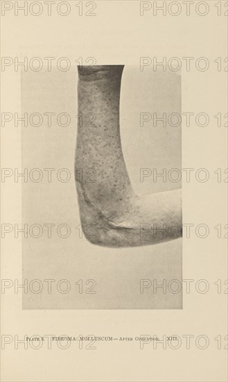 Fibroma Molluscum - After Operation; Charles B. Brigham, American, 1845 - 1903, Cambridge, Massachusetts, United States; 1876