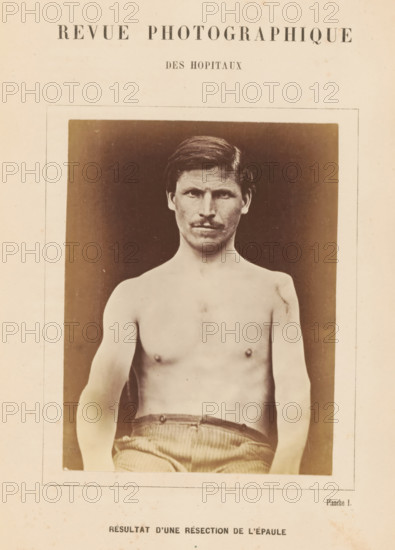 Result d'une résection de l'épaule, Portrait of an unknown man after a shoulder resection, photograph, page, inscription: 'Revue photographique, des hopitaux, Planche I.', c. 1865 - in or before 1870, photographer, paper, albumen print, height 127 mm x width 97 mm, historical persons, adult man, A sepia-toned photograph shows a shirtless man from the waist up, centered in a rectangular frame with a dark backdrop; he has short hair, a mustache, a neutral facial expression, visible shoulders and chest, and is wearing striped trousers at the waist with his arms relaxed at his sides.