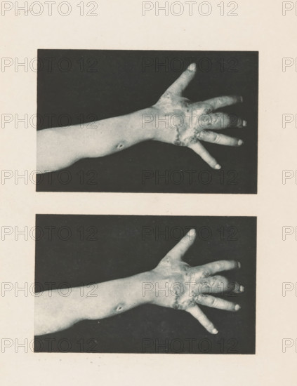 Two views of an arm with symptoms of skin lupus, page, photomechanical print, stereograph, photographer: Albert Ludwig Sigesmund Neisser, cliché maker: anonymous, c. 1884 - in or before 1894, paper, photoaquatint, height 175 mm x width 126 mm, lower arm, skin and venereal diseases, A grayscale image showing two rectangular photographs stacked vertically on a pale background, each containing an outstretched forearm and hand against a dark backdrop, the skin showing textured areas and irregular patches around the knuckles and back of the hand, fingers spread apart with visible fingernails, and a small round mark on the inner forearm.
