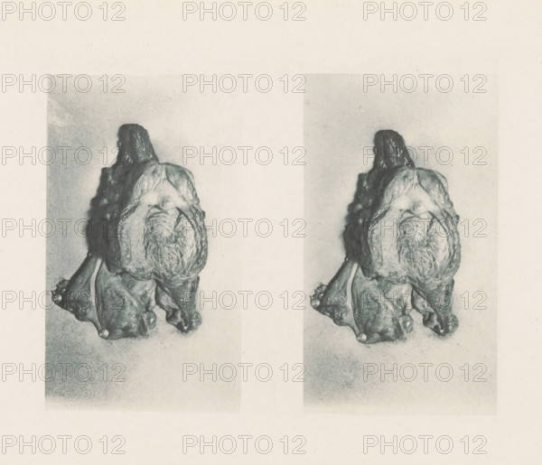 Two views of a prostate with hypertrophy of the lobes, page, photomechanical print, stereograph, photographer: Albert Ludwig Sigesmund Neisser, cliché maker: anonymous, c. 1884 - in or before 1894, paper, photoaquatint, height 126 mm x width 175 mm, diseases, male sexual organs, A faded monochrome print shows two vertically aligned, nearly identical images of an organic, irregularly shaped object with textured, layered surfaces and rounded protrusions, positioned against a pale, grainy background, each image framed by a subtle rectangular border.