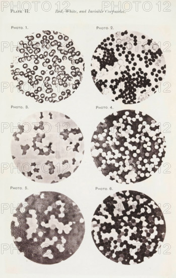 Six enlargements of blood cells, page, photomechanical print, number: 'Pl. II.', number: 'Photo. 1., Photo. 6.', photographer: Richard Norris, cliché maker: anonymous, c. 1872 - in or before 1882, paper, collotype, photoprint, height 213 mm x width 135 mm, Page opposite page 201., blood, A vertical page showing six circular microscope views arranged in two columns and three rows, each circle containing irregular dark and light shapes resembling clustered cells or particles against pale backgrounds; the top left circle shows ring-like dark outlines with pale centers, the top right contains many small solid dark round spots with a few pale rings, the middle left has scattered irregular dark blotches on a light ground, the middle right displays numerous pale round shapes over a darker mottled background, the bottom left shows larger pale rounded forms with dark surrounding areas, and the bottom right features densely packed dark round shapes interspersed with lighter areas.