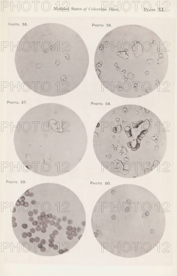 Six enlargements of colorless blood corpuscles, page, photomechanical print, number: 'Pl. XI.', number: 'Photo. 55., Photo. 60.', photographer: Richard Norris, cliché maker: anonymous, c. 1872 - in or before 1882, paper, collotype, photoprint, height 213 mm x width 135 mm, Page opposite page 210., blood, A vertical sheet showing six circular grayscale microscope views arranged in three rows and two columns, each circle containing various small pale shapes on a light background; the top left circle shows scattered irregular cloud-like outlines, the top right circle contains multiple small clustered and ringed forms with one larger irregular cluster, the middle left circle has a few faint rounded outlines and a small fuzzy cluster, the middle right circle displays a prominent irregular textured cluster surrounded by many small ringed shapes, the bottom left circle is filled with numerous round darker discs grouped toward one side, and the bottom right circle shows a few faint round outli...