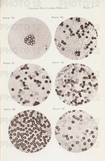 Six enlargements of blood cells, page, photomechanical print, number: 'Pl. V.', number: 'Photo. 19., Photo. 24.', photographer: Richard Norris, cliché maker: anonymous, c. 1872 - in or before 1882, paper, collotype, photoprint, height 213 mm x width 135 mm, Page opposite page 204., blood, A pale page shows a vertical arrangement of three pairs of circular microscope images, each circle containing clusters of round cells or disc-like forms in various densities and shades, with the top left circle featuring a central cluster of darker rounded shapes surrounded by a lighter background, the top right circle filled with many dark and light round elements overlapping irregularly, the middle left circle displaying scattered dark and faint round spots with some grouping, the middle right circle showing numerous round cells of varying darkness with some translucent areas, the bottom left circle densely packed with dark ringed discs against a light background, and the bottom right circle contain...