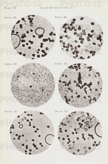 Six enlargements of blood cells and lymphocytes, page, photomechanical print, number: 'Pl. VI.', number: 'Photo. 25., Photo. 30.', photographer: Richard Norris, clichémaker: anonymous, c. 1872 - in or before 1882, paper, collotype, light print, height 213 mm x width 135 mm, Page opposite page 205., blood, A vertical page showing six circular grayscale microscopic images arranged in three rows, two columns, each circle containing various small round shapes and darker irregular spots; the top of the page has a small heading centered and a left-aligned plate label, and small labels beside each circular image; the circles display differing textures and densities of dots, rings, and clusters, with some circles containing larger dark rings or elongated dark areas, and the background of the page is a light off-white.