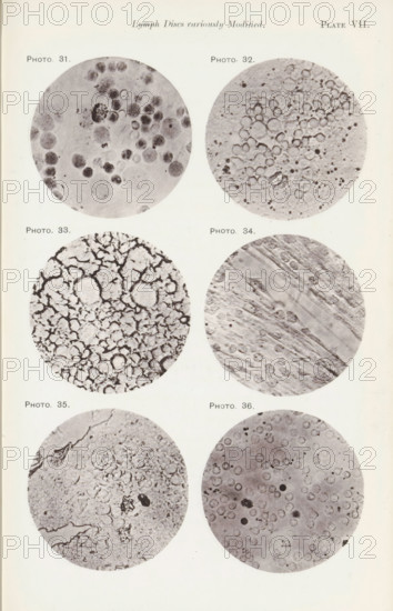Six enlargements of lymphocytes, page, photomechanical print, number: 'Pl. VII.', number: 'Photo. 31., Photo. 36.', photographer: Richard Norris, cliché maker: anonymous, c. 1872 - in or before 1882, paper, collotype, photoprint, height 213 mm x width 135 mm, Page opposite page 206., blood, A vertical page showing six circular grayscale microscope images arranged in two columns and three rows, each circle containing different textured patterns and clusters of rounded shapes; the top left circle shows various dark and light round spots of differing sizes on a mottled background, the top right circle displays many pale ringed circles densely packed toward the center with small speckles scattered around, the middle left circle contains a network of irregular dark lines forming enclosed rounded cells, the middle right circle shows diagonal striated bands overlaid with faint circular forms, the bottom left circle exhibits a coarse granular texture with uneven edges and scattered darker splo...