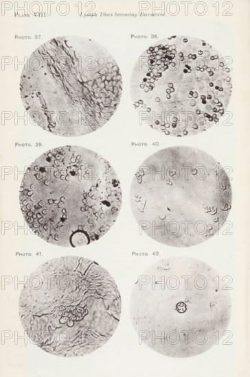 Six enlargements of lymphocytes, page, photomechanical print, number: 'Pl. VIII.', number: 'Photo. 37., Photo. 42.', photographer: Richard Norris, cliché maker: anonymous, c. 1872 - in or before 1882, paper, collotype, photoprint, height 213 mm x width 135 mm, Page opposite page 207., blood, Eight circular grayscale close-up images arranged in two vertical columns show varied textures and small round shapes. The top left circle contains fibrous streaks and clustered small rounded forms against a lighter background. The top right circle displays many small ringed discs scattered across the field with a dense cluster near the upper edge. The middle left circle shows numerous ringed discs concentrated toward the top and left edges with a darker circular outline near the bottom. The middle right circle has a few scattered ringed shapes and faint irregular marks on a mostly even background. The lower left circle reveals wrinkled, ridge-like textures with a small cluster of rounded forms nea...