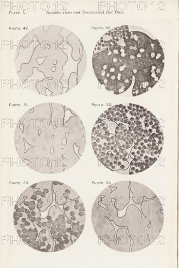 Six enlargements of blood after various procedures, page, photomechanical print, number: 'Pl. X.', number: 'Photo. 49., Photo. 54.', photographer: Richard Norris, clichémaker: anonymous, c. 1872 - in or before 1882, paper, collotype, light print, height 213 mm x width 135 mm, Page opposite page 209., blood, The image shows a vertical page with six circular grayscale illustrations arranged in three rows and two columns, each circle containing organic shapes and patterns; the top left circle has irregular outlined regions with light interior shading, the top right circle contains many small dark round spots clustered together with lighter irregular gaps, the middle left circle features faint rounded marks scattered with thin outlined shapes over a pale background, the middle right circle displays numerous densely packed dark circular elements interspersed with light irregular shapes and connecting lines, the bottom left circle shows clustered dark round forms along with pale curving part...