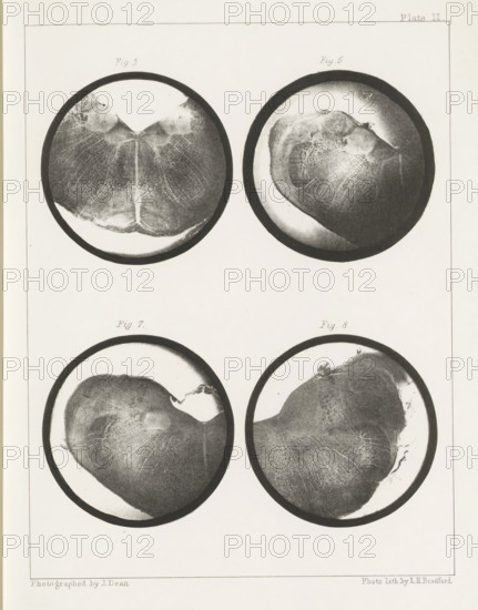 Four cross-sections of a medulla oblongata of a sheep, page, photomechanical print, number: 'Plate II. Fig. 5. Fig 6. Fig. 7. Fig. 8.', photographer: John Dean, printmaker: Bradford & Co, LH, c. 1854 - in or before 1864, paper, photolithography, height 301 mm x width 230 mm, brains, A pale rectangular sheet contains four circular grayscale images arranged two above two, each circle rimmed by a dark border and showing textured, irregular organic surfaces with varying light and dark shading. The top left circle shows a roughly symmetrical form with a central lighter vertical area and radiating fine striations, while the top right circle displays an asymmetrical rounded mass with mottled highlights and a lighter halo near the rim. The bottom left circle features a large rounded shape with subtle linear textures and a lighter curved edge, and the bottom right circle shows a similar rounded form with finer mesh-like patterns and a brighter area near its upper edge. The background of the she...