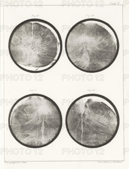 Four details of a human medulla oblongata, page, photomechanical print, number: 'Plate V. Fig. 17. Fig 18. Fig. 19. Fig. 20.', photographer: John Dean, printmaker: Bradford & Co, LH, c. 1854 - in or before 1864, paper, photolithography, height 301 mm x width 230 mm, brains, A vertically oriented sheet with four circular grayscale images arranged in two columns and two rows, each circle showing textured radial patterns and irregular lighter and darker areas within a dark outer rim, with subtle mottling and vein-like streaks; faint printed labels appear above each top circle and between the two rows, and a thin rectangular border frames the entire sheet.