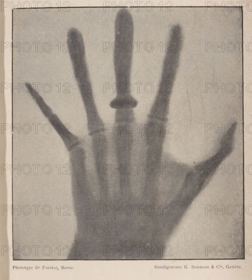 Revue Suisse de photographie, 1896, page, photomechanical print, maker: Dr. Foster, maker: G. Bonneau & Cie, c. 1891 - in or before 1896, paper, autotypie, height 140 mm x width 128 mm, X-ray examination, carpus and metacarpus, parts of the hand, A grainy monochrome image of a human hand seen from the palm side with fingers splayed, showing darker shadowy areas where the fingers and palm appear as semi-transparent silhouettes, with one finger topped by a darker rounded shape, all set against a lighter textured background within a rectangular border.