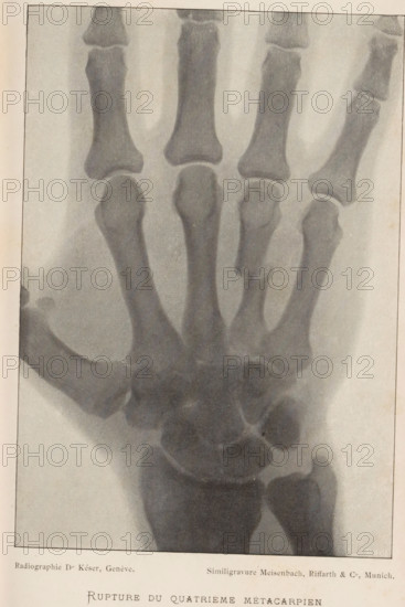 Rupture du Quatrième Métacarpien, X-ray of a hand with a broken metacarpal, page, photomechanical print, photographer: Dr. Késer, cliché maker: Meisenbach, Riffarth & Cie., Munich, c. 1893 - in or before 1898, Bavaria, paper, autotypie, height 167 mm x width 116 mm, X-ray examination, carpus and metacarpus, parts of the hand, A grayscale radiographic image of a human hand showing bones from the wrist through the finger phalanges, with visible metacarpal and phalangeal shafts and joint spaces; the bones appear with varied shading and grainy texture against a lighter background, and the image is framed by a thin border with a narrow margin around it.