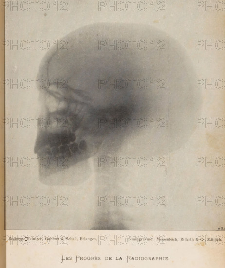 X-ray of a human skull, Les Progrès de la Radiography, page, photomechanical print, photographer: Reiniger, Gebbert & Schall, cliché maker: Meisenbach, Riffarth & Cie., Munich, c. 1893 - in or before 1898, Bavaria, paper, autotypie, height 147 mm x width 142 mm, X-ray examination, (human) skull, A faded grayscale image shows a side view of a human skull rendered in soft, grainy tones against a lighter background, with darker shading outlining the cranial dome, eye socket, nasal cavity, and jaw area; the lower portion of the image includes a pale rectangular border and a strip of aged paper with faint stains and small specks, and the overall appearance is textured with subtle spots and vertical streaks.