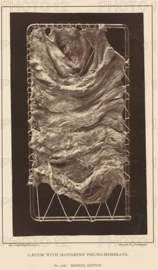 Caecum with Sloughing Pseudo-Membrane, page, photomechanical print, address: '1002 Arch St., Philadelphia.', number: 'No. 1060. MEDICAL SECTION.', photographer: Edward J. Ward, cliché maker: American Photo-Relief Printing Company, Philadelphia, c. 1874 - in or before 1879, North America, paper, Woodburytype, height 198 mm x width 120 mm, anatomical specimen, intestines, A vertical photographic image shows a textured, layered organic sheet stretched and secured by cords to a rectangular metal frame, the sheet displaying folds, ridges, and fibrous surfaces with varied light and shadow; the frame rests against a dark background and is bordered by a pale mat with a printed strip along the bottom.