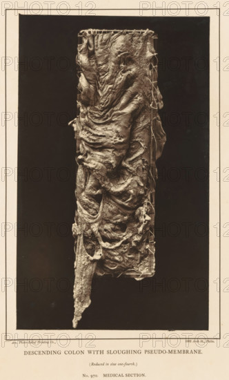 Descending Colon with Sloughing Pseudo-Membrane, page, photomechanical print, address: '1002 Arch St., Philadelphia', number: 'No. 970. MEDICAL SECTION.', inscription: '(Reduced in size one-fourth)', photographer: Edward J. Ward, cliché maker: American Photo-Relief Printing Company, Philadelphia, c. 1874 - in or before 1879, North America, paper, Woodburytype, height 200 mm x width 122 mm, anatomical specimen, intestines, A tall vertical photographic image centered on a rectangular dark background shows a long irregular organic mass suspended within a narrow rectangular frame; the mass has layered, wrinkled, and folded surfaces with many torn, ribbonlike strands and rounded cavities, with a tapered, elongated lower portion that hangs below the frame and a thicker upper section gathered at the top, all rendered in a sepia tone against a pale border.