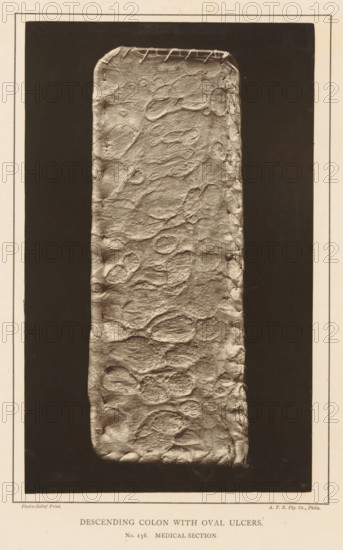 Descending Colon with Oval Ulcers, page, photomechanical print, number: 'No. 136. MEDICAL SECTION.', photographer: Edward J. Ward, cliché maker: American Photo-Relief Printing Company, Philadelphia, c. 1874 - in or before 1879, North America, paper, Woodburytype, Woodburytypepie, height 202 mm x width 124 mm, anatomical specimen, intestines, ulcer, A vertical rectangular panel with rounded corners fills the center, showing a textured surface with irregular oval depressions and raised areas, stitched along the top edge and partially along the right side; the panel sits on a dark rectangular background framed by a lighter border, and a light margin surrounds the whole image.