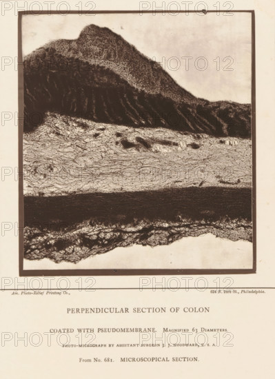 Enlargement of a membrane in a piece of large intestine, Perpendicular Section of Colon Coated with Pseudomembrane, page, photomechanical print, inscription: 'Magnified 63 diameters., Photo-micrograph by assistant surgeon JJ Woodward, USA, From No. 681. MICROSCOPICAL SECTION.', address: '624 N. 24th St., Philadelphia.', photographer: Joseph Janvier Woodward, cliché maker: American Photo-Relief Printing Company, Philadelphia, c. 1874 - in or before 1879, North America, paper, Woodburytype, Woodburytypepie, height 127 mm x width 115 mm, anatomical specimen, intestines, A rectangular framed image with a high-contrast, textured horizontal composition occupying the upper portion of a pale page; the top area shows a dark, irregular mound with dense stippled texture that slopes down into a band of lighter, finely wrinkled, layered patterns, beneath which lies a broad dark horizontal stripe with a rough surface, followed by another textured, fibrous band at the bottom of the framed area; the p...