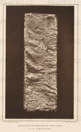 Strained section of colon with swollen cavities, Follicular Ulceration of the Colon, page, photomechanical print, number: 'No. 206. MEDICAL SECTION.', address: '1002 Arch St., Phila.', photographer: Edward J. Ward, cliché maker: American Photo-Relief Printing Company, Philadelphia, c. 1874 - in or before 1879, North America, paper, Woodburytype, height 203 mm x width 124 mm, anatomical specimen, intestines, A tall vertical rectangular strip occupies the center of the image, showing a textured, irregular surface with folds, ridges, and rough patches; the strip's edges are secured with a series of loops of thin cord or thread that run along both sides, and the surface displays various depressions, raised areas, and small holes with uneven, wrinkled material that appears layered and fibrous; the central strip is set against a dark rectangular background framed by a lighter border with a narrow inner line, and the overall image has a sepia-toned, aged photographic appearance.