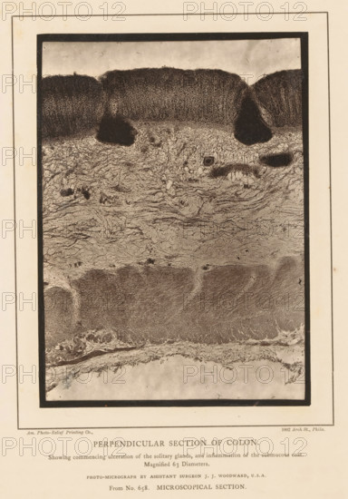 Perpendicular Section of Colon, Enlargement of the formation of ulcers in cavities in a piece of colon and inflammation of the lower layer, page, photomechanical print, address: '1002 Arch St., Phila.', inscription: 'Showing commencing ulceration of the solitary glands, and inflammation of the submucous coat., Magnified 63 Diameters., Photo-micrograph by assistant surgeon JJ Woodward, USA, From No. 658. MICROSCOPICAL SECTION.', photographer: Joseph Janvier Woodward, cliché maker: American Photo-Relief Printing Company, Philadelphia, c. 1874 - in or before 1879, North America, paper, Woodburytype, Woodburytypepie, height 159 mm x width 115 mm, anatomical specimen, intestines, ulcer, A rectangular photographic plate bordered by a dark frame sits centered on aged paper, showing a vertical grayscale microscopic image with distinct horizontal bands of texture; the top band features a dark, densely stippled layer with rounded, mound-like protrusions and irregular darker spots, the middle ban...