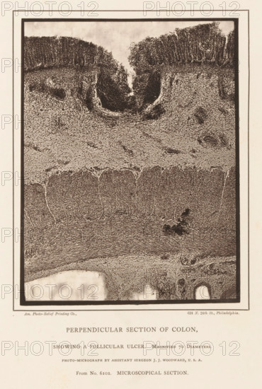 Enlargement of a distended cavity in a piece of large intestine, Perpendicular Section of Colon, Showing a Follicular Ulcer, page, photomechanical print, inscription: 'Magnified 70 Diameters., Photo-micrograph by assistant surgeon JJ Woodward, USA, From No. 6102. MICROSCOPICAL SECTION.', address: '624 N. 24th St., Philadelphia.', photographer: Joseph Janvier Woodward, cliché maker: American Photo-Relief Printing Company, Philadelphia, c. 1874 - in or before 1879, North America, paper, Woodburytype, height 153 mm x width 117 mm, anatomical specimen, intestines, ulcer, A rectangular sepia-toned image framed by a double border shows a vertical cross-sectional view with textured layers and cellular patterns. The top portion features a dark, densely stippled region with an inward-curving depression and rough edges, while the middle displays a lighter, grainy band with varied texture and scattered denser spots. Below this band are vertical column-like structures with fine granular detail, be...