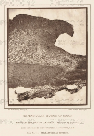 Perpendicular Section of Colon, through the Edge of an Ulcer, Enlargement of the edge of an ulcer in a piece of colon, page, photomechanical print, address: '624 N. 24th St., Philadelphia.', inscription: 'Magnified 63 Diameters., Photo-micrograph by assistant surgeon JJ Woodward, USA, From No. 711. MICROSCOPICAL SECTION.', photographer: Joseph Janvier Woodward, cliché maker: American Photo-Relief Printing Company, Philadelphia, c. 1874 - in or before 1879, North America, paper, Woodburytype, Woodburytypepie, height 138 mm x width 113 mm, anatomical specimen, intestines, ulcer, A rectangular framed image shows a textured, irregularly shaped dark mass against a lighter background, with dense granular areas and layered, wavy striations; the top right edge of the dark mass forms a prominent rounded protrusion into the pale space, and the lower portion displays fibrous, swirling patterns transitioning into a more compact, dotted texture near the center; a narrow border surrounds the framed ...