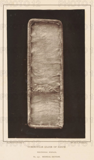 Tubercular Ulcer of Ileum, Stretched piece of ileum with an ulcer due to tuberculosis, page, photomechanical print, number: 'Peritoneal surface., No. 257. MEDICAL SECTION.', address: '1002 Arch St., Philadelphia.', photographer: Edward J. Ward, cliché maker: American Photo-Relief Printing Company, Philadelphia, c. 1874 - in or before 1879, North America, paper, Woodburytype, Woodburytypepie, height 198 mm x width 120 mm, anatomical specimen, intestines, ulcer, A vertically oriented rectangular photograph shows a long narrow strip with rounded corners centered on a dark background, bordered by a light mat with a thin inner frame; the strip has a textured fabric-like surface with visible creases, stitched edges, and a cluster of irregular raised areas near the middle, and the overall image palette is sepia-toned.