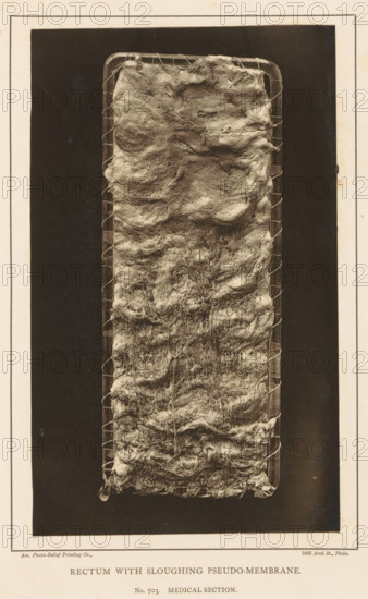 Rectum with Sloughing Pseudo-Membrane, page, photomechanical print, address: '1002 Arch St., Phila.', number: 'No. 703. MEDICAL SECTION.', photographer: Edward J. Ward, cliché maker: American Photo-Relief Printing Company, Philadelphia, c. 1874 - in or before 1879, North America, paper, Woodburytype, Woodburytypepie, height 199 mm x width 120 mm, anatomical specimen, intestines, A vertically oriented rectangular object fills most of the image, framed by a darker background and a lighter border; the central surface appears irregular and textured with layered, wrinkled, and fibrous material that forms ridges, folds, and matted strands, and is held at the edges by a coarse grid or lattice that wraps around the perimeter.