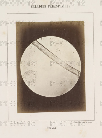 Microscopic image of the disease alopecia areata, Pelade, photograph, page, inscription: 'Ad naturam phot. et pinx.', inscription: 'Maladies parasitaires', number: '14', photographer: A. de Montméja, c. 1860 - c. 1868, paper, albumen print, height 119 mm x width 90 mm, microscope, skin and venereal diseases, A vertically oriented aged page with a rectangular framed image centered on it, showing a circular pale field against a dark background; a long textured diagonal band crosses the circular field from upper left toward lower right and a rough irregular cluster shape appears near the lower left inside the circle, with small scattered specks and marks visible on the pale circle and the surrounding dark area; the paper shows slight discoloration and faint stains around the edges.