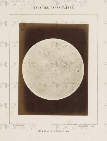 Pityriasis versicolor, Microscope image of the disease pityriasis versicolor, photograph, page, number: '19', inscription: 'Maladies parasitaires.', inscription: 'Ad naturam phot. et pinx.', photographer: A. de Montméja, c. 1860 - c. 1868, paper, albumen print, height 120 mm x width 91 mm, microscope, skin and venereal diseases, A vertical page with a centered rectangular dark panel containing a large pale circular disc that fills most of the panel, the disc showing fine irregular speckles and faint textured markings, the surrounding panel is deep brown with subtle wear and lighter edges, the page around the panel is a warm off-white with a thin double-lined rectangular border and small scattered spots and smudges.