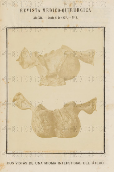 Dos Vistas de Una Mioma Intersticial del Útero, Two views of a uterus with a benign tumor formed by muscle cells, photograph, page, inscription: 'REVISTA MÉDICO-QUIRÚRGICA, Año XIV. - Junio 8 de 1877. - No 3.', c. 1872 - in or before 1877-06-08, photographer, paper, albumen print, height 141 mm x width 110 mm, womb, uterus, internal tumors, A vertical page with a faded cream background and a thin black double border contains two sepia-toned photographic views of an irregular organic mass with smooth and textured surfaces and paired winglike extensions at opposite sides, the top view showing the mass oriented with one prominent rounded lobe and a pedestal-like base and the lower view showing a broader rounded form with a central groove and outward curving winglike projections, the page showing small spots of discoloration and slightly darkened edges.