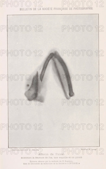 X-ray of a pheasant bone, Aileron de faison montrant la fracture de l'os, un esquille et un plomb, page, photomechanical print, inscription: 'Epreuve obtenue, &lt, L'OPTIQUE. &gt, ', photographer: Albert Londe, cliché maker: Louis Geisler, c. 1886 - in or before 1896, paper, autotypie, height 181 mm x width 120 mm, walker and runner birds: pheasant, bones in general (human body), A faded monochrome rectangular image bordered by a thin dark line sits on a pale background, showing a blurred, arching object with two curved parallel bands forming a pointed apex and tapering ends, accompanied by an amorphous irregular mass at the base where one band meets it, the tones varying from light gray to darker gray with soft, diffuse edges and a grainy texture throughout.