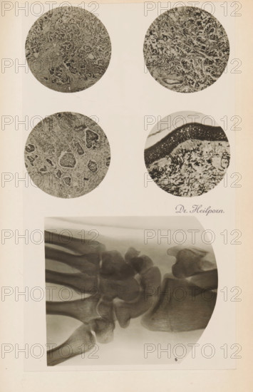 Four enlargements of x-rays, photograph, page, name: 'Drs. Hauchamps et Steinhaus', c. 1904 - in or before 1909, photographer, paper, gelatin silver print, developing gelatin silver print, height 97 mm x width 104 mm, Photo in section at the back of the book., X-ray examination, A vertical off-white page displays four circular grayscale microscopic images arranged in a grid near the top and a large rounded-corner grayscale radiographic image occupying the lower half; the circular images show dense textured patterns with varied granular and fibrous structures, one circle exhibiting a layered dark band above a lighter, mottled lower area, while the others contain irregular cellular-like clusters and porous regions; the radiographic image shows overlapping bone structures with smooth curved edges and translucent shading, highlighting joint contours and adjacent bone shapes against a lighter background.