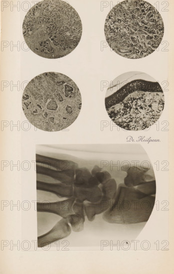 X-ray of a wrist, photograph, page, name: 'Dr. Heilporn', c. 1904 - in or before 1909, photographer, paper, gelatin silver print, developing gelatin silver print, height 76 mm x width 88 mm, Photo in section at the back of the book., X-ray examination, carpus and metacarpus, parts of the hand, A vertical cream page shows four circular grayscale microscopic images arranged near the top, each containing textured, mottled patterns with dense clustered shapes and fibrous areas; to the right of the lower right circle a cursive signature-like mark appears but is not described, and below the circles a large rectangular grayscale X-ray image of a wrist and hand bones occupies the lower half of the page, showing overlapping rounded bone ends, long narrow metacarpal shafts, joint spaces, and soft-tissue shadows with a curved white margin on the right side.