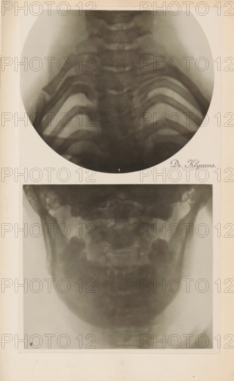 X-ray of ribs, photograph, page, name: 'Dr. Heilporn', c. 1904 - in or before 1909, photographer, paper, gelatin silver print, developing gelatin silver print, height 88 mm x width 106 mm, Photo in section at the back of the book., X-ray examination, ribs, A vertical image showing two black-and-white radiographic photographs mounted on a light background, the upper one circular and the lower one rectangular; the upper radiograph displays a series of curved, layered bone structures forming a symmetrical rib-like pattern fading toward the center, while the lower radiograph shows a rounded, jaw-like bone structure with darker shadowed areas at the sides and a lighter central region, both images surrounded by a pale mat with slight age-toned discoloration.