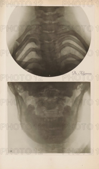X-ray of an upper and lower jaw, photograph, page, name: 'Dr. Klynens.', c. 1904 - in or before 1909, photographer, paper, gelatin silver print, developing gelatin silver print, height 89 mm x width 103 mm, Photo in section at the back of the book., X-ray examination, jaw (human), A vertical sheet showing two grayscale circular and rectangular radiographic images of a head and upper chest area mounted on a light background, the top image is a round radiograph showing a frontal view of the upper spine and rib outlines with soft gradients of gray and dark curved bone structures, and the lower rectangular radiograph shows a frontal view of the lower skull and jaw with blurred bone contours and symmetric darker areas at the sides, both images bordered by a pale mat and surrounded by an off-white page.