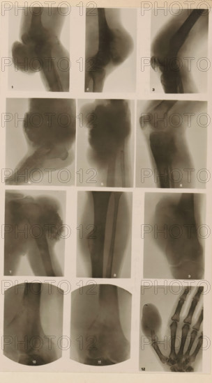 Twelve x-rays of different joints, photograph, page, name: 'Dr. Hauchamps.', c. 1904 - in or before 1909, photographer, paper, gelatin silver print, developing gelatin silver print, height 194 mm x width 106 mm, Photo in section at the back of the book., X-ray examination, (human) skeleton, A vertical montage of grayscale radiographic images arranged in a grid, showing various limb and joint views. The top row contains three narrow vertical X-ray panels depicting rounded bone structures and joint contours. The second row has three larger vertical panels showing bone ends and surrounding soft-tissue silhouettes in different orientations. The third row includes three images with irregular bone masses and elongated shaft views. The bottom rows contain two rounded-corner vertical images with diffuse bone and soft-tissue shading and a final panel showing a hand with visible metacarpal and phalangeal bones and a rounded detached structure nearby. The entire sheet has a pale border and small ...