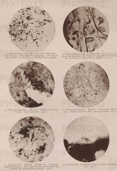 Six microscope images of bacteria, including tuberculosis and leprosy bacilli, page, photomechanical print, number: 'Tafel VI.', inscription: '31. bacteria with end-to-end spores in faulendem Fleischwasser. Deckglassrockenpräparat. Those Spores with Fuchsin, those Bacilli with Methylenblau produced. 1000:1. 32. Tuberculosis Bacilli in Phthisis Sputum. Deckglassrockenpräparat. The Tuberculosis Bacilli with Fuchsin are produced with Methylenblau. 1000:1. 33. Tuberculosis bacilli. Mensch. Phthisian Lunge. Schnitt. Gentianaviolett. 500:1. 34. Tuberculosis bacilli. human Tuberculosis Meningitis. Schnitt durch die Pia. Gentianaviolett. 500:1. 35. Leprosy bacilli. Mensch. Hautknoten. Deck glass sauce stick preparation. The Leprosy Bacilli with Fuchsin are produced with Methylenblau. 1000:1. 36. Rotz bacilli. Feldmaus, Lunge. Schnitt. Methylenblau. 500:1.', photographer: Carl Günther, Berlin, maker: Friedrich Julius Klinkhardt, Leipzig, c. 1880 - in or before 1890, Saxony, paper, collotype, ph...