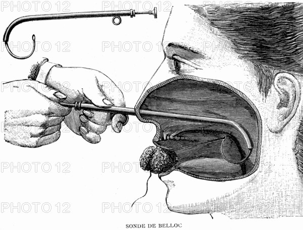Belloc probe, cannula.Buffering of the nasal cavity
1887  ( Weekly journal by Dr. Gerard in Paris )