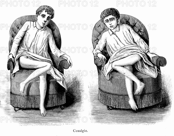 Coxalgia ( Tuberculosis of the hip ). Weekly magazine " Illustrated medecine "
by Dr. Gerard. Paris 1887