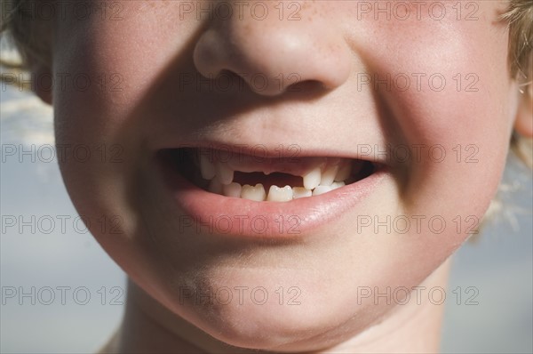 Boy with missing teeth smiling. Date : 2007