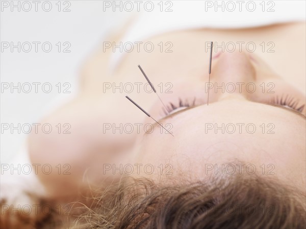 Woman receiving acupuncture. Date : 2008